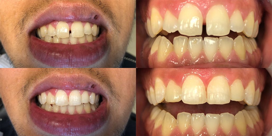 Tooth Gems – Triple Crown Dentistry